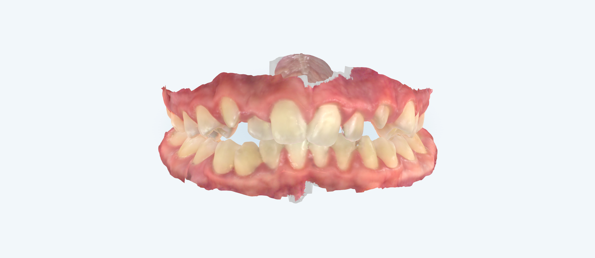 Openbite treatment comparison case 1 before